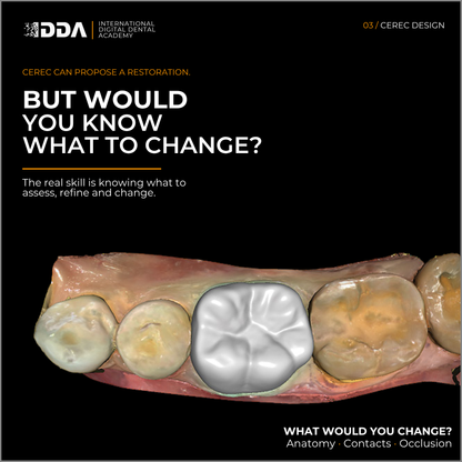CEREC Design: Same Day Crowns, Onlays and Short Span Bridges with Confidence