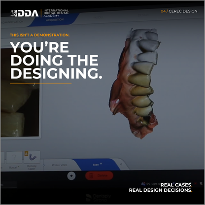 CEREC Design: Same Day Crowns, Onlays and Short Span Bridges with Confidence